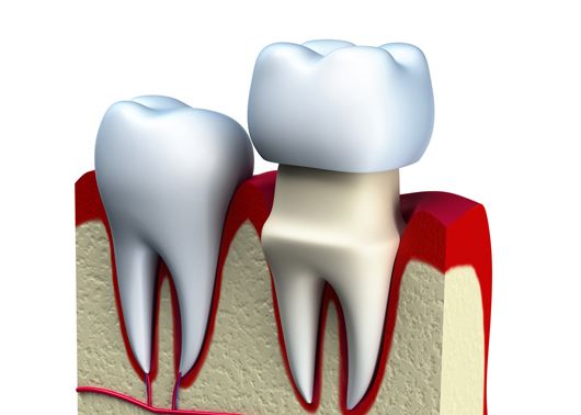 The Importance of Crown Placement After Root Canal Treatment