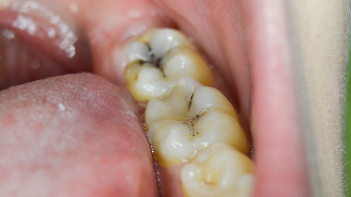 Cavity For Tooth