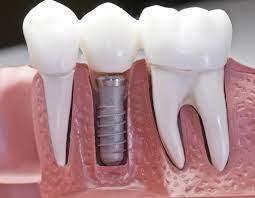 Dental Implants – Post-Operation Instructions