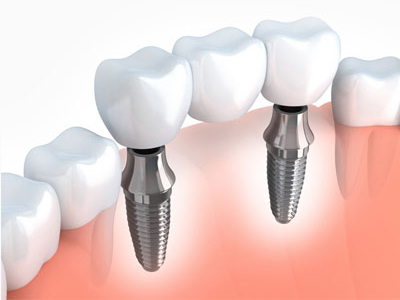 Cost of Dental Implants – Factors That Affect the Cost of Dental Implants