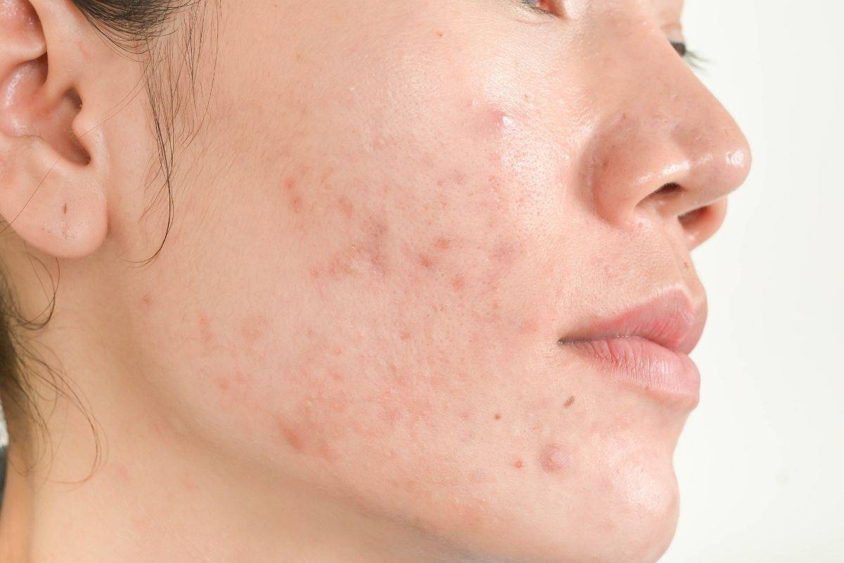 Acne Causes – What Causes Acne?