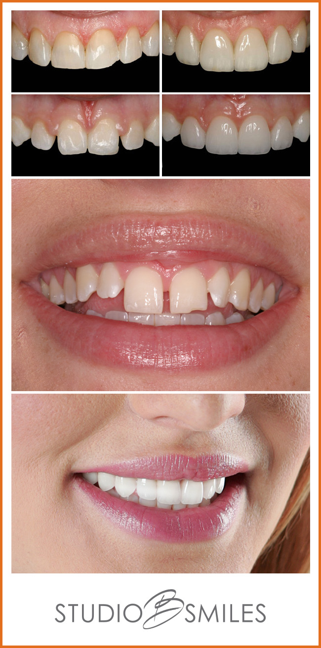 Minimal Intervention Dentistry Techniques: Saving Teeth Without the Drill