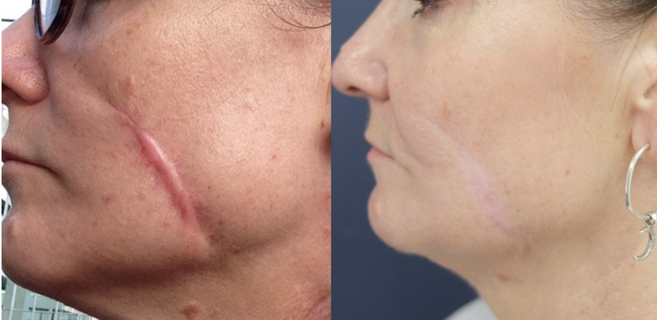 Gender-Affirming Top Surgery Scar Minimization Techniques
